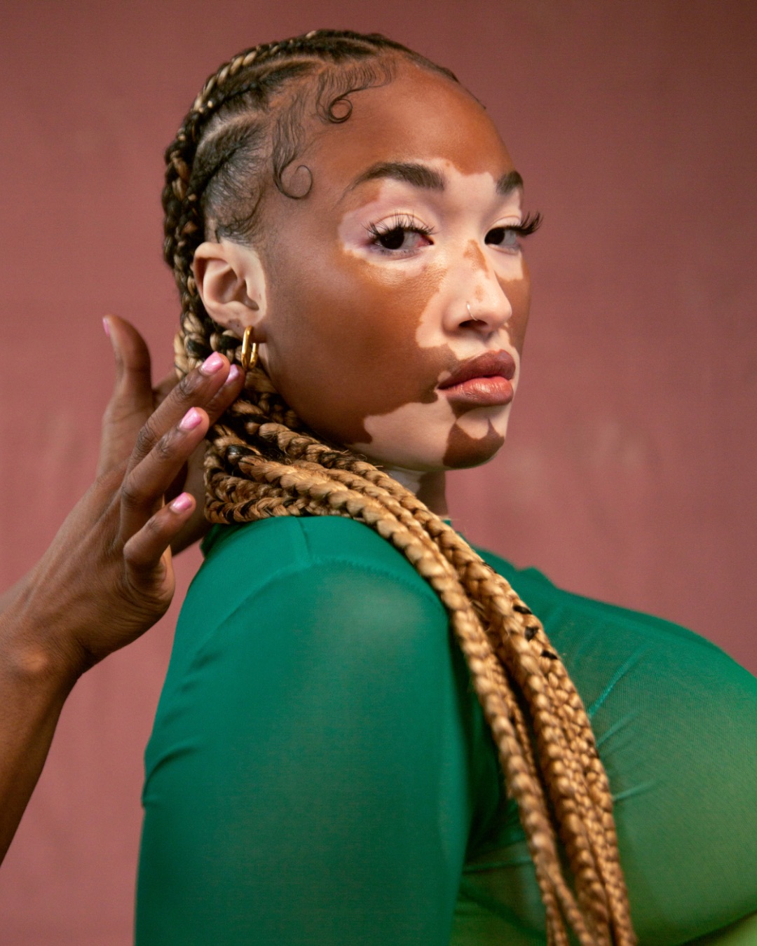 Black model with vitiligo shows off beauitful braids